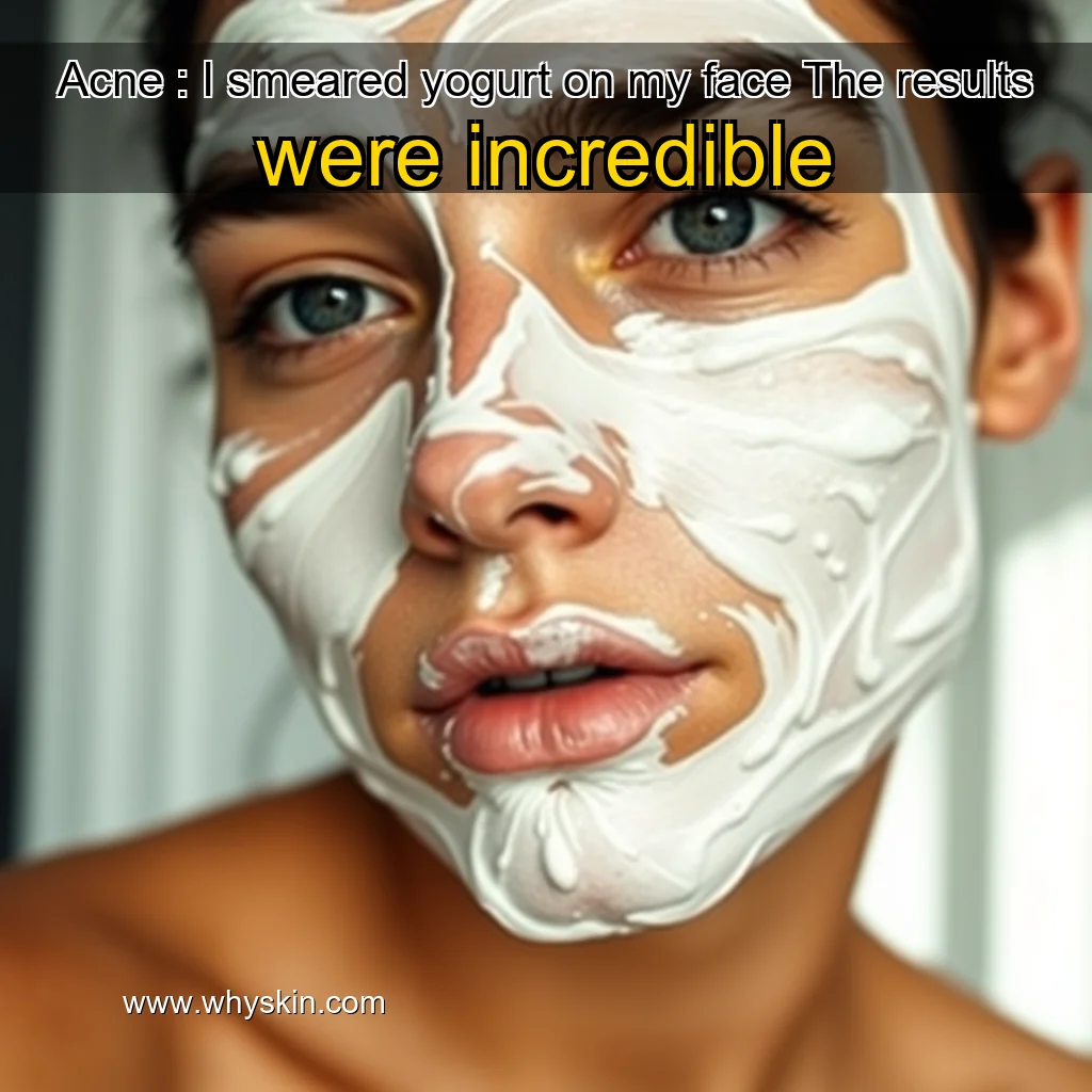 You are currently viewing Acne : I smeared yogurt on my face  The results were incredible