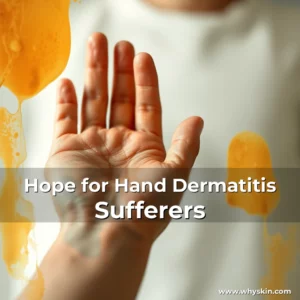 Read more about the article Hope for Hand Dermatitis Sufferers