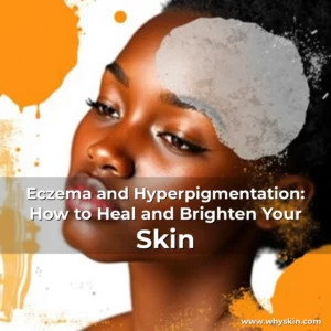 Read more about the article Eczema and Hyperpigmentation: How to Heal and Brighten Your Skin